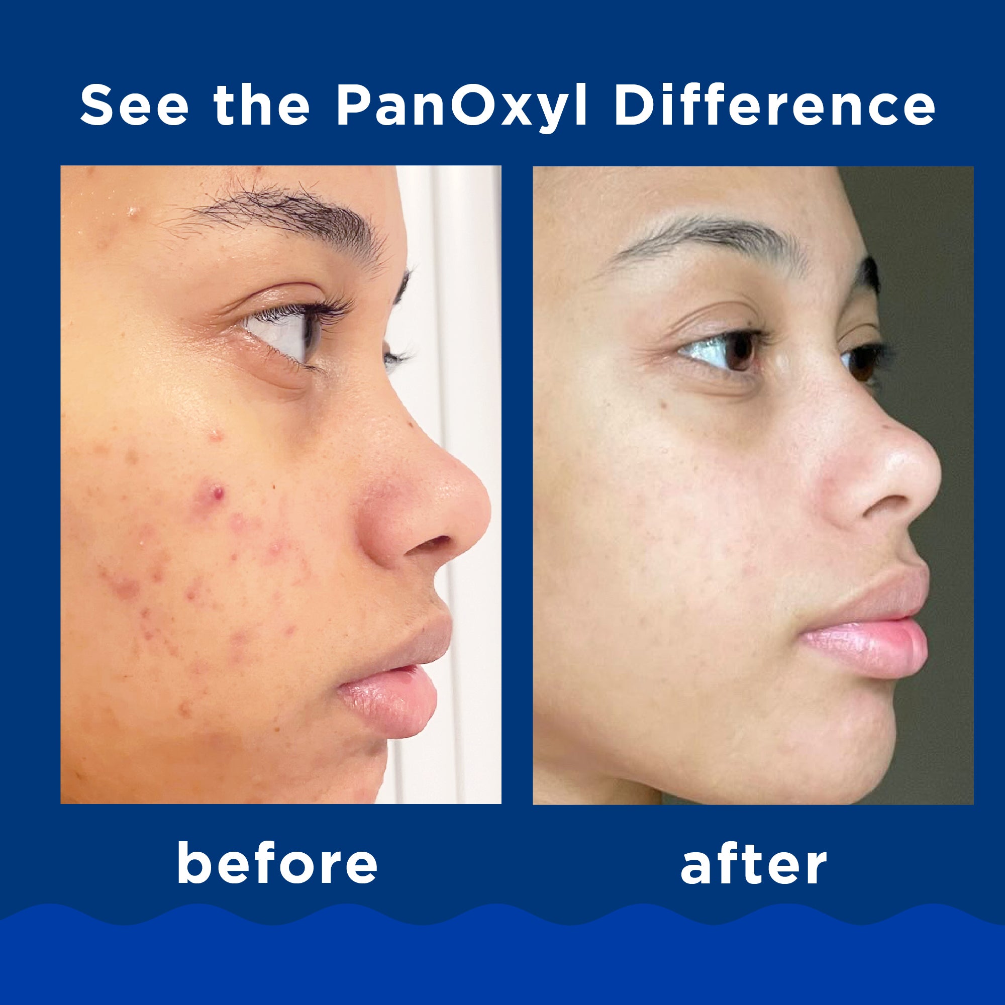PanOxyl - Acne Foaming Wash Benzoyl Peroxide 10% Maximum Strength